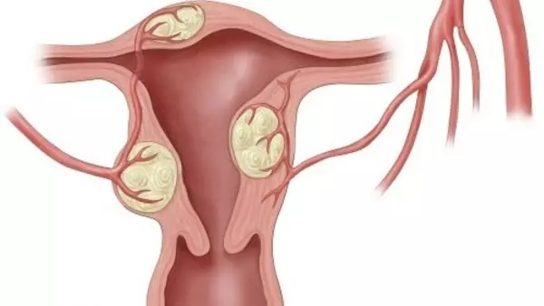 U xơ tử cung có thể khiến bụng to bất thường